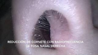 Radiofrecuencia de cornetes [upl. by Dnomal]