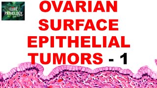 OVARIAN TUMORS  Part 2  SEROUS AND MUCINOUS TUMORS Etiopathogenesis and morphology [upl. by Swor]