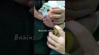 Babinski reflex in infants [upl. by Munsey]