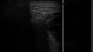 Masseter M Zygomatic Arch Temporal region pus DTJournal Issue 9 2019 [upl. by Joby635]