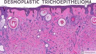 Desmoplastic Trichoepithelioma AIP France 2021  Case 2 [upl. by Cann538]