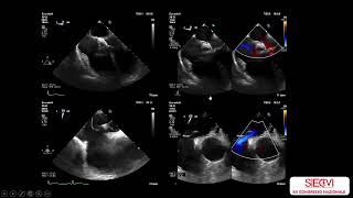 TEE and TTE integrated approach in percutaneous PFO closure procedure complication monitoring [upl. by Ahsekat661]