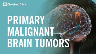 What Are Primary Malignant Brain Tumors [upl. by Mulac]