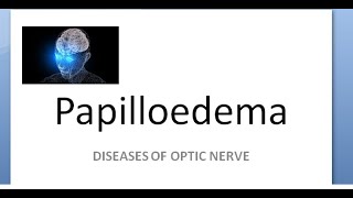 Ophthalmology Papilledema amaurosis fugax sometimes loss of vision cant see Hayreh theory [upl. by Aynatal]