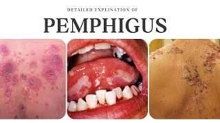 Pemphigus Types Causes Clinical Features Differential Diagnosis and Treatment [upl. by Lrigybab]