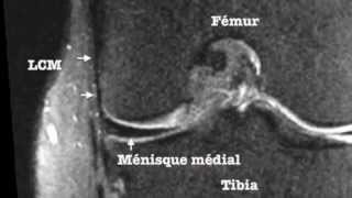 Plan Ligamentaire Médial interne du Genou [upl. by Oiramej954]