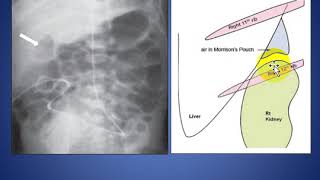 Signs of Pneumoperitoneum [upl. by Menard]