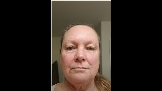 Day 10 Fluorouracil 5 Treatment Basal Cell Carcinoma Actinic Keratosis 11423 5FU Efudex [upl. by Acisset339]