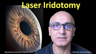 Laser Iridotomy the works Mahesh Ramchandani explores all about laser for angle closure glaucoma [upl. by Schug898]