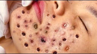 Top five dark Face blackhead removal on Nose  blackhead Removal [upl. by Leterg]