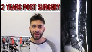 Microdiscectomy 2 Years Post Surgery L5S1 [upl. by Petromilli422]