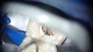 squirt obturation lower molar [upl. by Nylimaj]