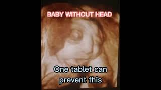 baby without head and prevention  anencephaly folicacid ultrasound findings of anencephaly [upl. by Kristi37]