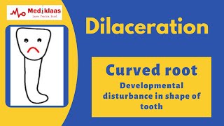 Dilaceration l Developmental tooth alteration l Oral pathology l Mediklaas [upl. by Moureaux]