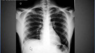 Chest xray pneumoperitonuem air under diaphragms [upl. by Socin]