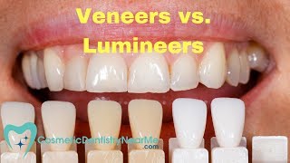 Veneers vs Lumineers [upl. by Lefty735]