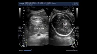 Ultrasound Video showing Oligohydromnios  almost Anhydramnios  with Pregnancy of 30 weeks [upl. by Vinna]