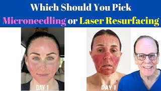 Should You Get Microneedling or Laser Resurfacing  Plastic Surgeons Advice [upl. by Aihsyak]