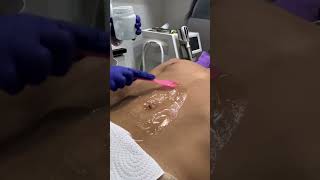 👉Depilación rápida y sin dolor ✨ depilacionlaser depilacion depilar alania clinicalania [upl. by Henghold319]