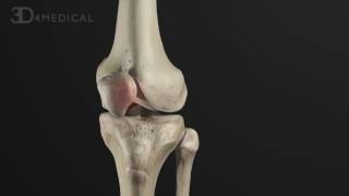 Anterior Cruciate Ligament Pathology and Management  Animated Tutorial [upl. by Roch]