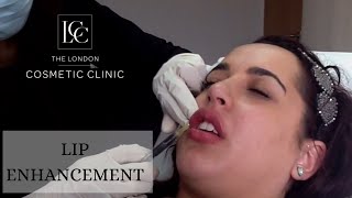 Lip Enhancement Dermal Filler Treatment [upl. by Bobbie917]