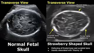 Fetal Head Ultrasound Normal Vs Abnormal Images  CloverleafLemonStrawberry Sign Skull USG [upl. by Gemma]