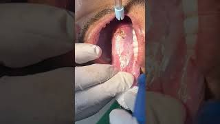 LEUKOPLAKIA REMOVAL [upl. by Sam130]