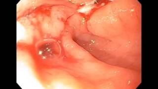 Gastric Outlet Obestruction from Pyloric Ulcers [upl. by Amme887]