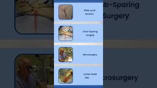 Liposarcoma Screening amp Treatment Options [upl. by Nnarual]