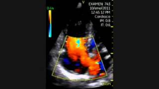 VSCAN Atrial Septal Defect Pocket ultrasound Comunicación interauricular [upl. by Nassir499]