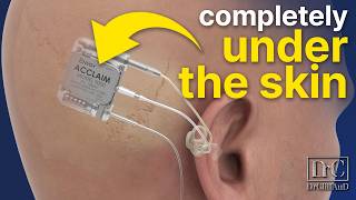 100 INVISIBLE Cochlear Implant  Acclaim by Envoy Medical [upl. by Akihsay]