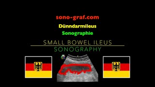 Sonographie  Dünndarmileus [upl. by Nylad]