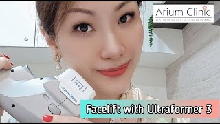 Facelift with Ultraformer 3 HIFU at Arium Clinic [upl. by Switzer21]