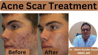 Acne Scar Treatment Results  Acne Scars  Kayakalp Laser Clinic [upl. by Trebreh]