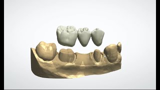 Conception en CFAO d’un Bridge Postérieur Mandibulaire sur 3Shape Guide Complet [upl. by Eatnuahs]