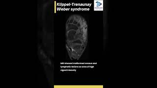 Klippel Trenaunay weber syndrome [upl. by Eecal]