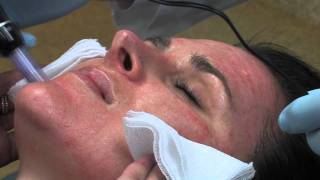 Dr Mark B Taylor Review of Dermapen Micro Needling  Gateway Aesthetics [upl. by Karl]