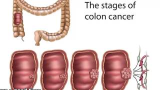 Cuidado con los pólipos en el colon [upl. by Othe342]