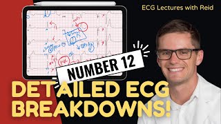 Improve your EKG Skills test yourself  ECG No 12 [upl. by Esinned]