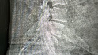 Lumbar Sacralization with Advanced Spondylosis  Louisiana Ring Dinger®️ [upl. by Isla870]