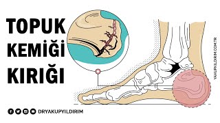 Topuk Kemiği Kırığı  Prof Dr Yakup YILDIRIM [upl. by Ostap]