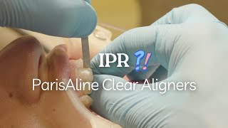 Performing IPR with ParisAline Clear Aligners A Simple Guide [upl. by Kathrine]