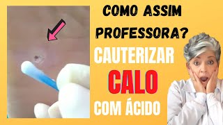 Cauterizar Calo com Ácido Como Assim Professora [upl. by Carlock]