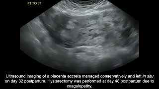 Placenta accreta spectrum conservative management and coagulopathy [upl. by Fish]