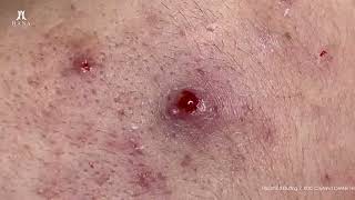 Big Cystic Acne Blackheads Extraction Blackheads amp Milia Whiteheads Removal Pimple Popping [upl. by Ccasi]