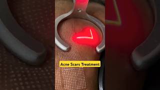 Laser Treatments for Acne Scars  Acne Scar Treatments fractional laser prpforface shorts [upl. by Lleze848]