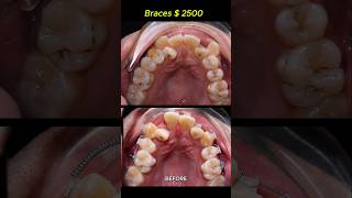 Cost  2500 for this case Braces crooked teeth braces orthodontist dentist [upl. by Igic108]