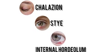 Chalazion vs External Hordeolum Stye vs Internal Hordeolum  Explained 👁️ [upl. by Alegnave]