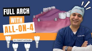 Full Arch with Allon4  Allon4 Implants  Dr Kathurias Dentistry  Dental Implant [upl. by Godding]