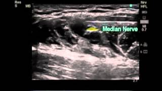 How to Ultrasound Guided Axillary Brachial Plexus Nerve Block [upl. by Adnarahs]